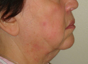 Facelift Before and After Pictures Philadelphia, PA