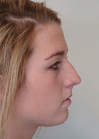 Rhinoplasty Before and After Pictures Philadelphia, PA