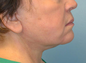 Facelift Before and After Pictures Philadelphia, PA