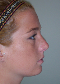 Rhinoplasty Before and After Pictures Philadelphia, PA