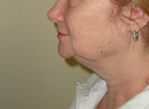 Facelift Before and After Pictures Philadelphia, PA