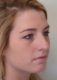 Rhinoplasty Before and After Pictures Philadelphia, PA