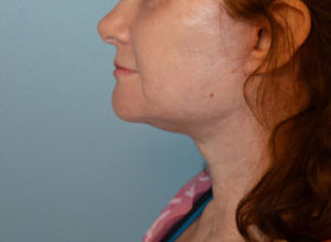 Facelift Before and After Pictures Philadelphia, PA