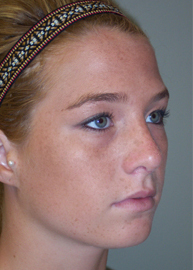 Rhinoplasty Before and After Pictures Philadelphia, PA