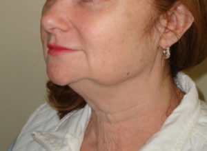 Facelift Before and After Pictures Philadelphia, PA