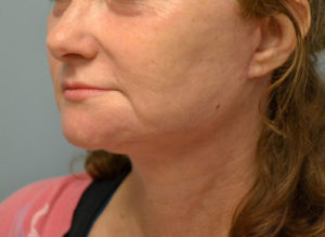 Facelift Before and After Pictures Philadelphia, PA