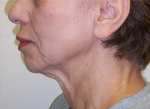 Facelift Before and After Pictures Philadelphia, PA