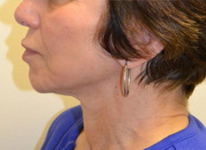 Facelift Before and After Pictures Philadelphia, PA