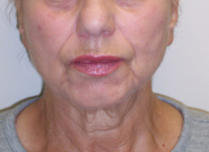 Facelift Before and After Pictures Philadelphia, PA