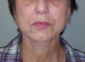 Facelift Before and After Pictures Philadelphia, PA