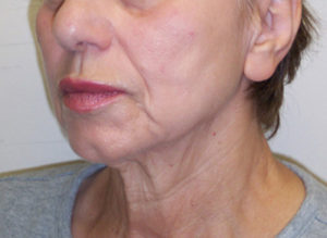 Facelift Before and After Pictures Philadelphia, PA