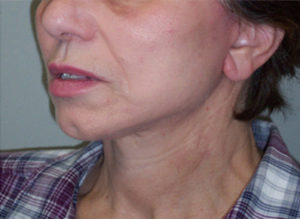 Facelift Before and After Pictures Philadelphia, PA