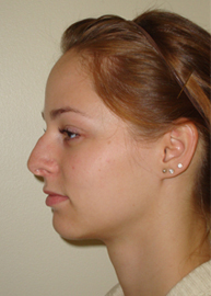 Rhinoplasty Before and After Pictures Philadelphia, PA