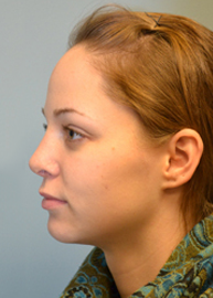 Rhinoplasty Before and After Pictures Philadelphia, PA