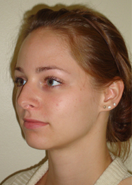 Rhinoplasty Before and After Pictures Philadelphia, PA