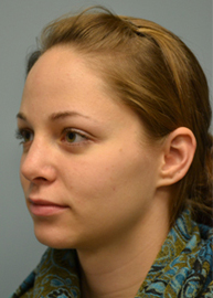 Rhinoplasty Before and After Pictures Philadelphia, PA