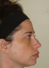 Rhinoplasty Before and After Pictures Philadelphia, PA