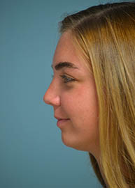 Rhinoplasty Before and After Pictures Philadelphia, PA