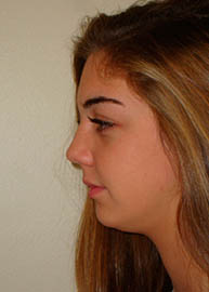 Rhinoplasty Before and After Pictures Philadelphia, PA