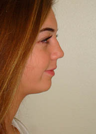 Rhinoplasty Before and After Pictures Philadelphia, PA