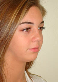 Rhinoplasty Before and After Pictures Philadelphia, PA