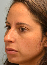 Rhinoplasty Before and After Pictures Philadelphia, PA