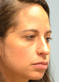 Rhinoplasty Before and After Pictures Philadelphia, PA