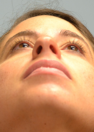 Rhinoplasty Before and After Pictures Philadelphia, PA