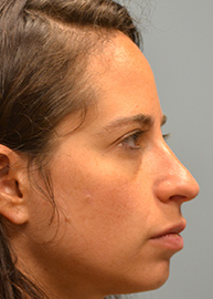 Rhinoplasty Before and After Pictures Philadelphia, PA