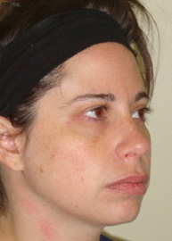 Rhinoplasty Before and After Pictures Philadelphia, PA