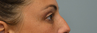 Eyelid Surgery Before and After Pictures Philadelphia, PA