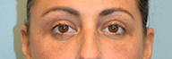 Eyelid Surgery Before and After Pictures Philadelphia, PA