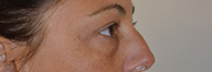 Eyelid Surgery Before and After Pictures Philadelphia, PA
