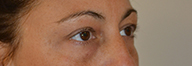 Eyelid Surgery Before and After Pictures Philadelphia, PA