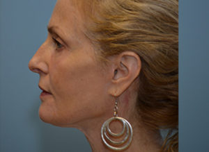 Facelift Before and After Pictures Philadelphia, PA