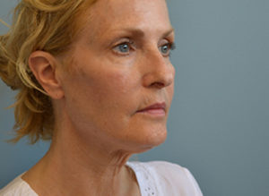 Facelift Before and After Pictures Philadelphia, PA