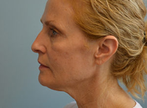 Facelift Before and After Pictures Philadelphia, PA