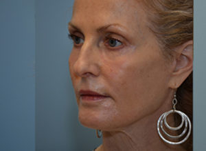 Facelift Before and After Pictures Philadelphia, PA