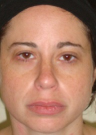 Rhinoplasty Before and After Pictures Philadelphia, PA