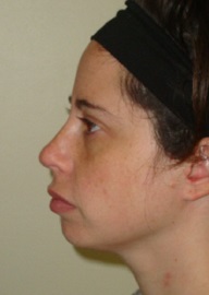 Rhinoplasty Before and After Pictures Philadelphia, PA