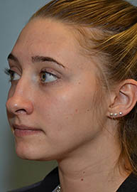 Rhinoplasty Before and After Pictures Philadelphia, PA