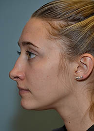 Rhinoplasty Before and After Pictures Philadelphia, PA