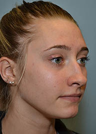 Rhinoplasty Before and After Pictures Philadelphia, PA