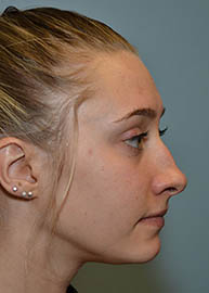 Rhinoplasty Before and After Pictures Philadelphia, PA