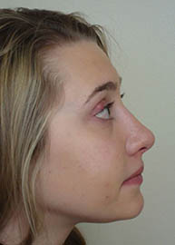 Rhinoplasty Before and After Pictures Philadelphia, PA