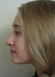 Rhinoplasty Before and After Pictures Philadelphia, PA