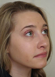 Rhinoplasty Before and After Pictures Philadelphia, PA