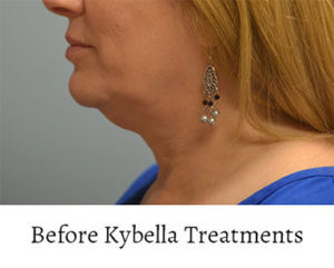 Kybella™ Before and After Pictures Philadelphia, PA