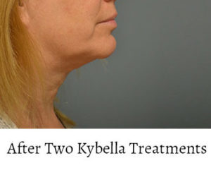 Kybella™ Before and After Pictures Philadelphia, PA