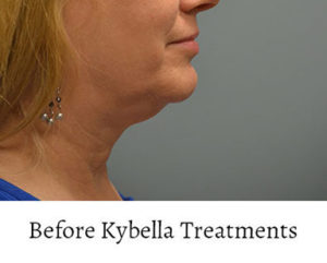 Kybella™ Before and After Pictures Philadelphia, PA
